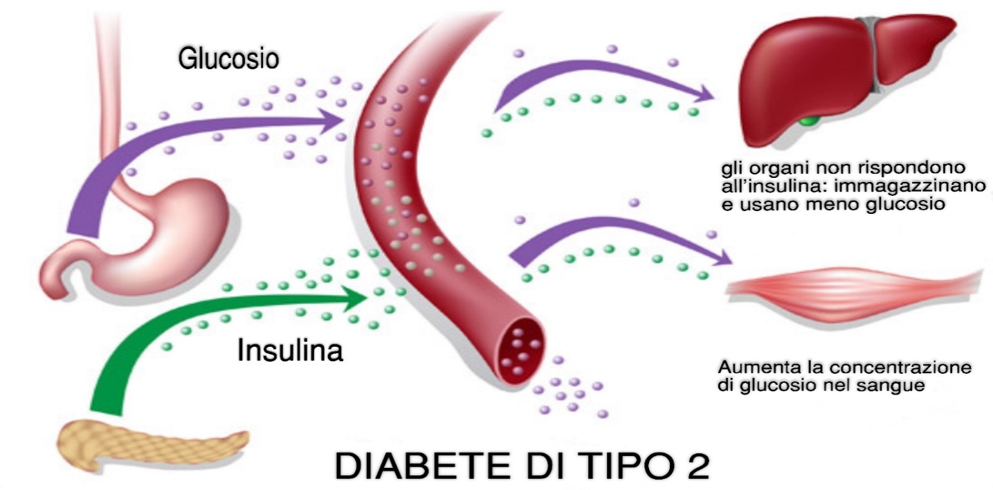 Diabetes: Causes, Symptoms and Modern Treatment Methods